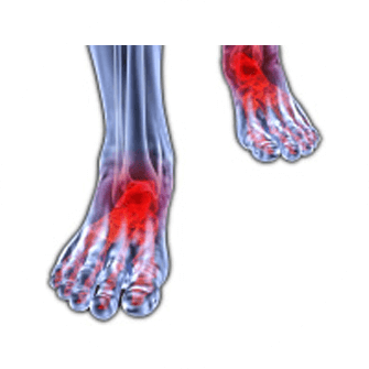 inflammation-morton-neuroma