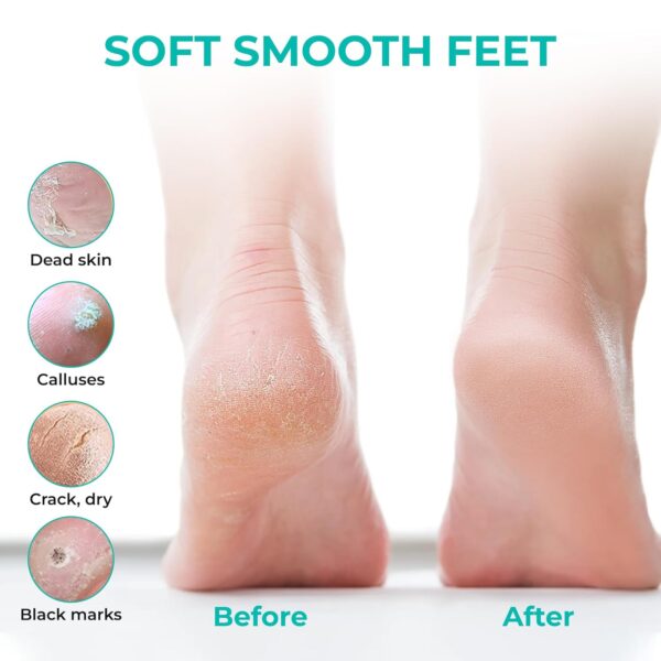 Happy Feet Foot Peel Mask, 03 Packs Original Exfoliant Foot Peel Mask, Callus Remover for Rough Cracked Dry Feet Dead Skin, Gift for Mom Dad - Image 5